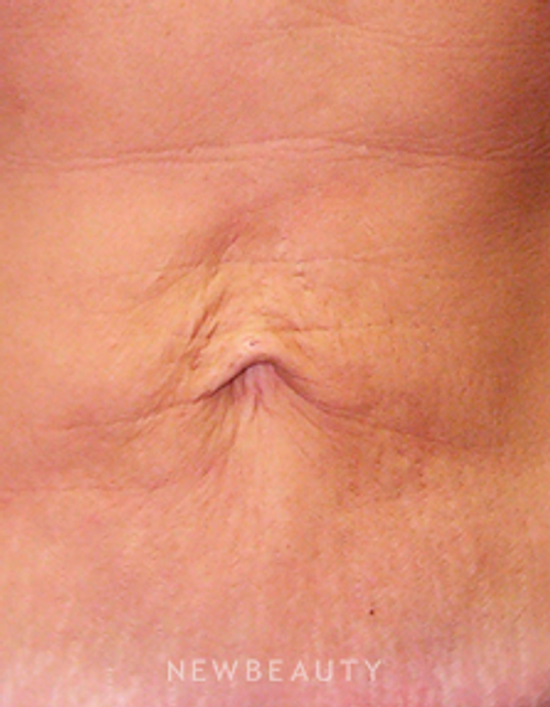 Dr. Ruth Hillelson Skin Tightening, Energy-Based - Before