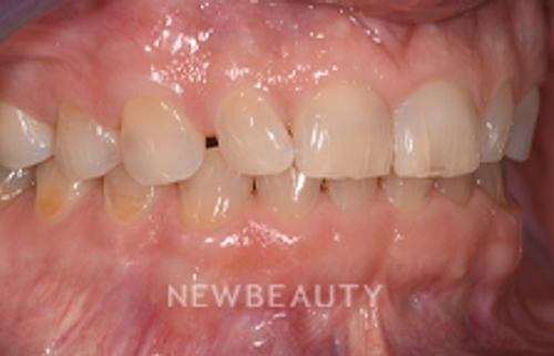 Dr. Sara Cummins - Smile Makeover - 14738055 - Before
