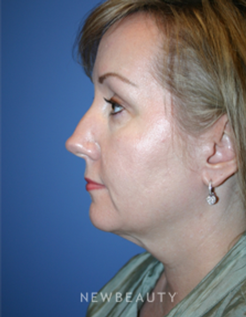 Dr. Kelly Bomer - Facelift - Before
