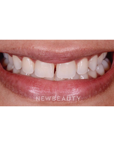 Dr. Husam Almunajed - Smile Makeover - Before