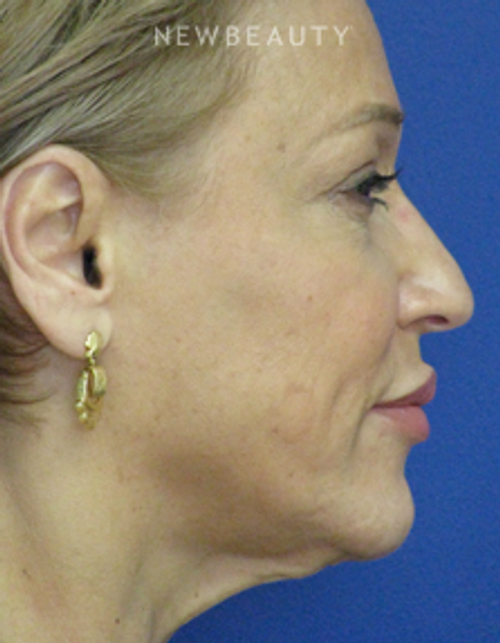 Dr. Joseph Russo - Full-Face Rejuvenation (Face EBG) - Before