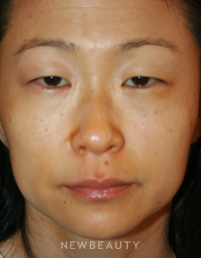Dr. John Kang - Blepharoplasty - Before