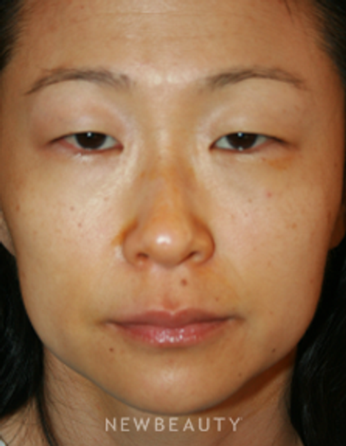 Dr. John Kang - Blepharoplasty - Before