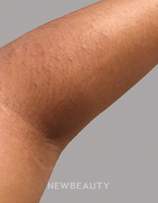 Dr. Anna Chacon - Eczema - 34284272 - After