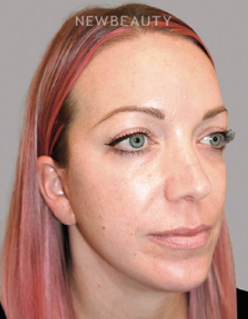 Dr. Sanjay Grover - Facelift - 49726612 - After