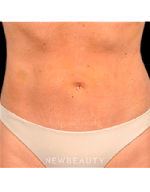 Dr. Bradley Bengtson Liposuction - After