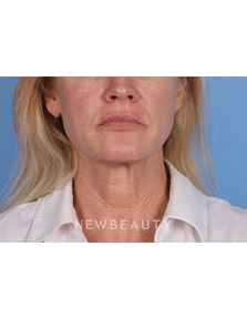 Dr. Kelly Bomer - Chemical Peels - Before