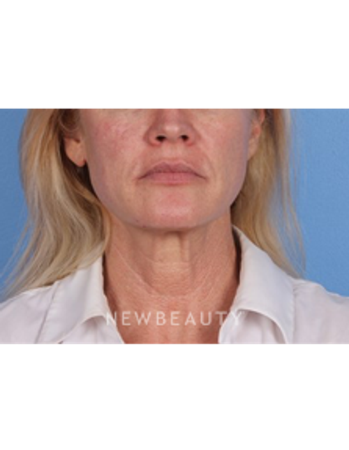 Dr. Kelly Bomer - Chemical Peels - Before
