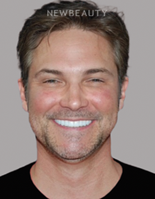 Dr. Salvator La Mastra - Smile Makeover-46109543 - After