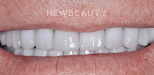 Dr. Salvator La Mastra – Smile Makeover – 46107191 - After
