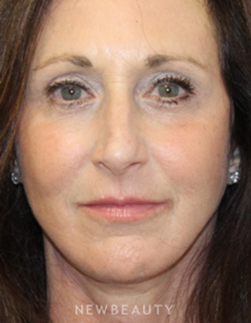 Dr. Dilip Madnani - Facelift - After