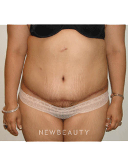 Dr. Michael Horn Tummy Tuck - After