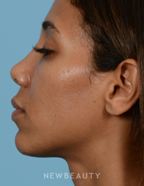 Dr. Jeffrey B. Wise - Nasal Tip Refinement - After