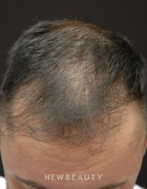 Dr. Jeffrey B. Wise - Hair Transplant - Before