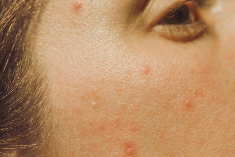 A Dermatologist-Approved Guide to Acne-Clearing Laser Treatments