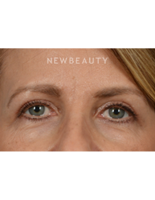 Dr. Jeffrey Wise - Eyelift - After