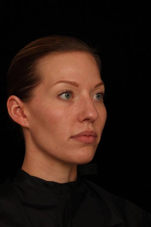 Dr. Jennifer M. Segal - Brighter Appearance - Before