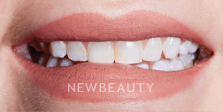 Dr. Nathan Hoffman - Gum Lift, Teeth Whitening & Veneers - Before