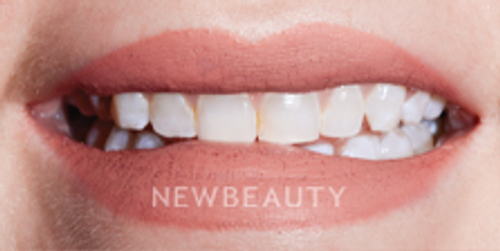 Dr. Nathan Hoffman - Gum Lift, Teeth Whitening & Veneers - Before