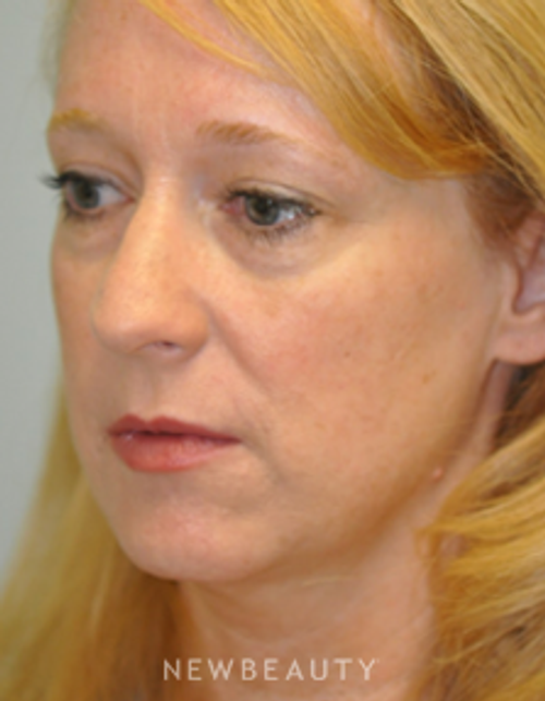 Drs. Lieberman & Parikh - Lower Blepharoplasty - Before