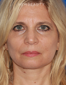 Dr. Konstantin Vasyukevich - Upper and Lower Blepharoplasties - After
