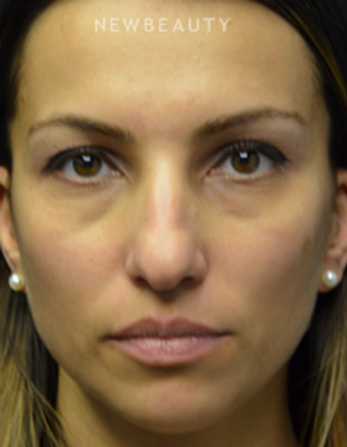 Dr. B. Aviva Preminger - Rhinoplasty - Before
