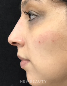 Dr. Julie Russak - Nonsurgical Rhinoplasty - After