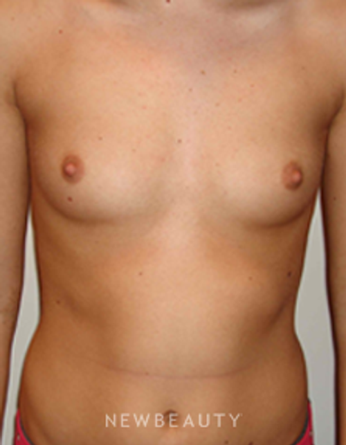 Dr. Michael Horn Breast Augmentation - Before