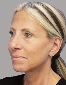 Dr. Dilip Madnani - Facelift -  45284088 - After