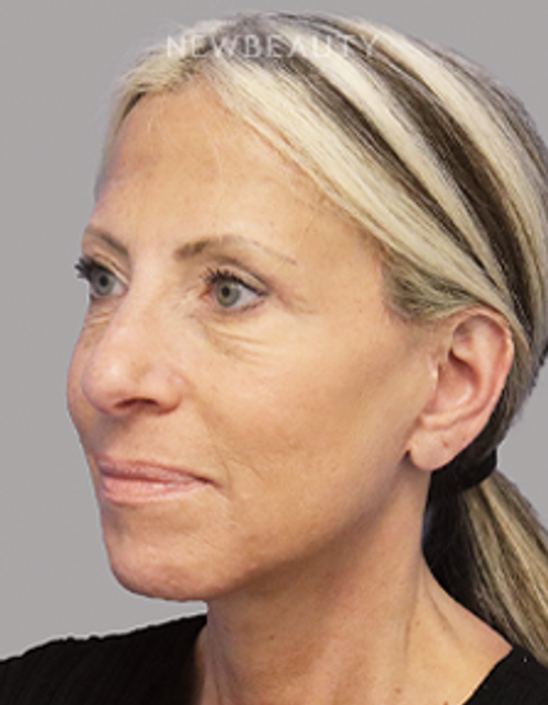 Dr. Dilip Madnani - Facelift -  45284088 - After