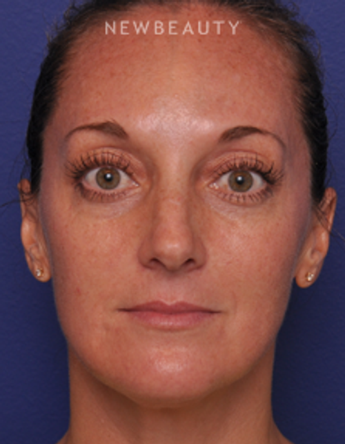Dr. Alan J. Durkin - Injectables and Fillers - After