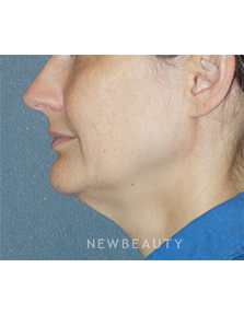 Dr. Min Ahn - Mini-Facelift With Necklift - Before