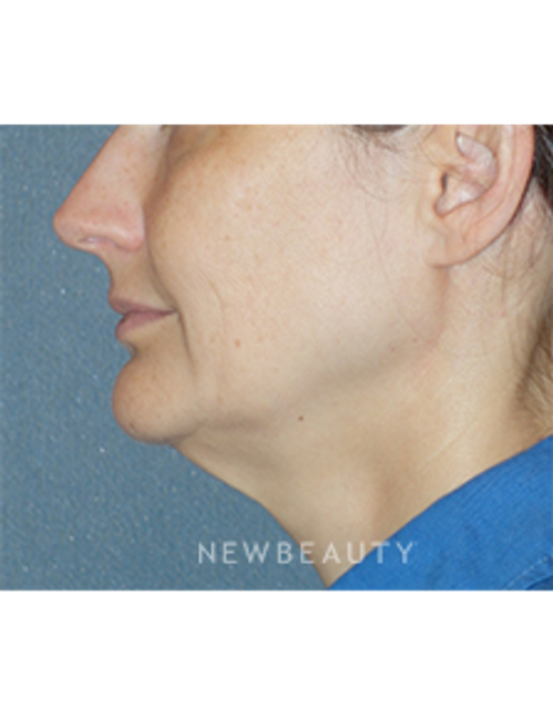 Dr. Min Ahn - Mini-Facelift With Necklift - Before