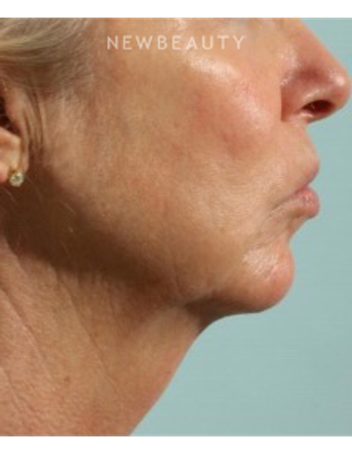 Dr. Marina Peredo - Firmatherapy for Sagging Skin - After