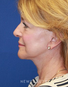 Dr. Dillip D. Madnani - Necklift - After