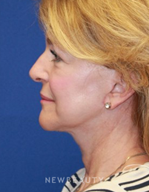 Dr. Dillip D. Madnani - Necklift - After
