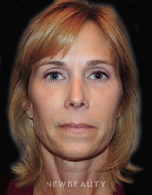 Dr. Kelly Bomer Liquid Facelift - Before