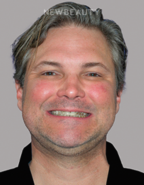 Dr. Salvator La Mastra - Smile Makeover-46109543 - Before