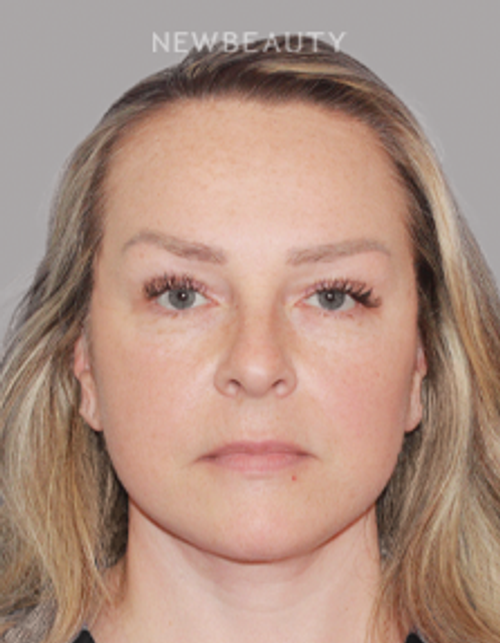 Dr. Konstantin Vasyukevich – Deep Plane Face and Neck Lift – 46903887 - After