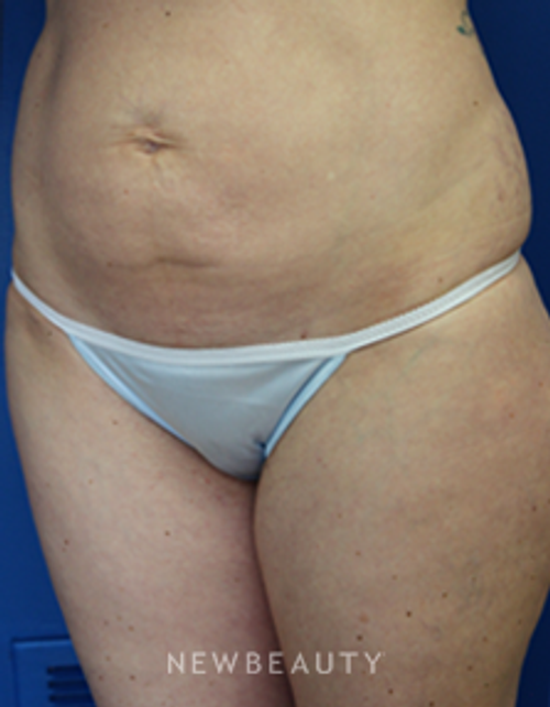 Dr. Joseph Russo - Mommy Makeover - Before