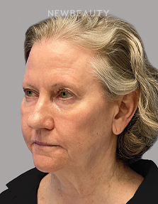 Dr. Paul Afrooz – Beautiful Transformation – 36269784 - Before