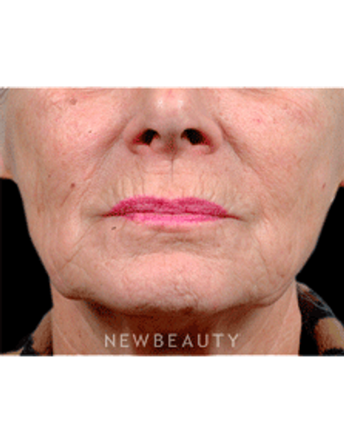 Dr. Steven Bloch Lasers and Light-Based Treatments - Before
