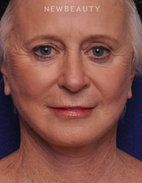 Dr. Alan Durkin - Limited Incision Facelift - After