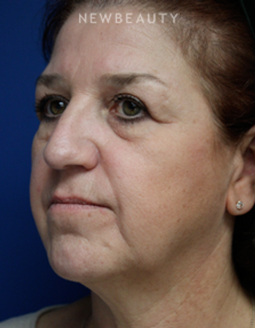 Dr. Joseph Russo - Remarkable Results (Face EBG) - Before