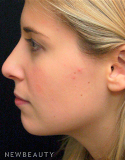 Dr. Mokhtar Asaadi Rhinoplasty - After
