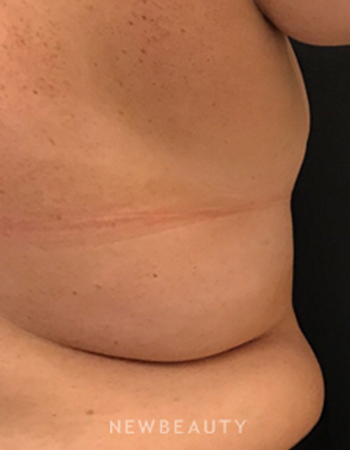 Dr. Janet Allenby - CoolSculpting - Before