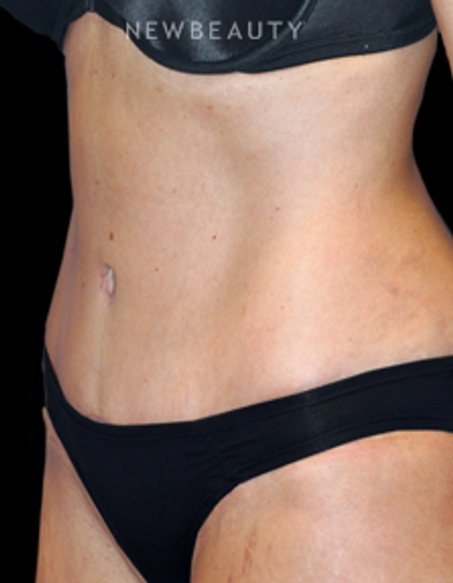 Dr. Bryan W. Gawley - Tummy Tuck with Lipo - After