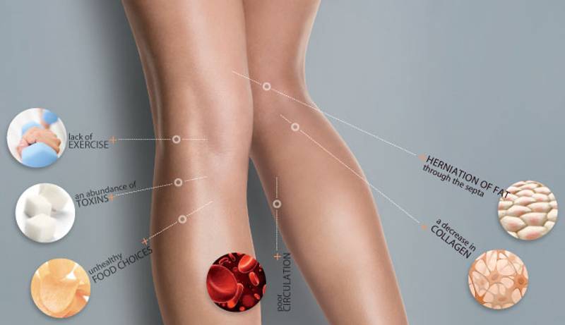 Cellulite Blogpost
