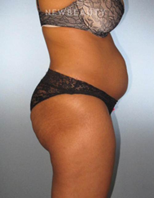 Dr. German Newall - Feminine Rejuvenation - Before