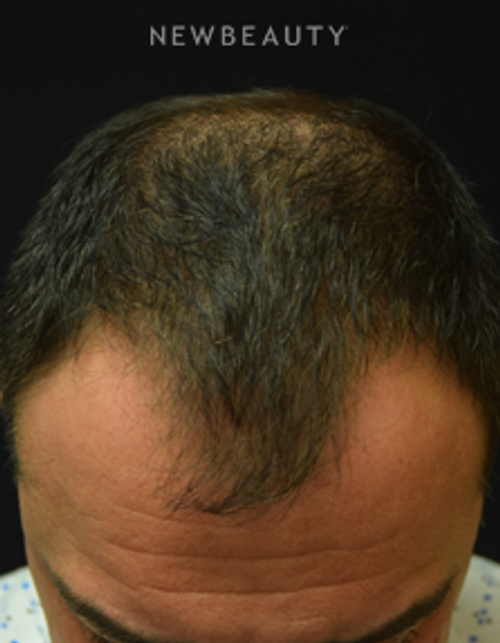Dr. Jeffrey B. Wise - Thinning Hair Resotration - Before